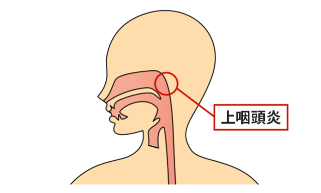 症状の該当箇所のイラスト